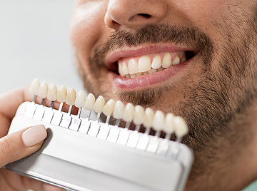 How To Quickly And Effectively Revamp Your Smile Using Dental Veneers