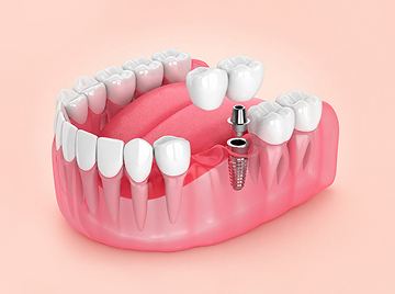 Dental Fixed Bridge vs. Removable Bridge: Pros And Cons