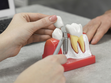 How Do You Become A Candidate For Dental Implants?