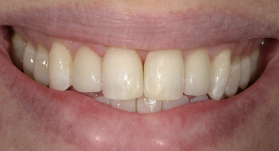 Peg Laterals