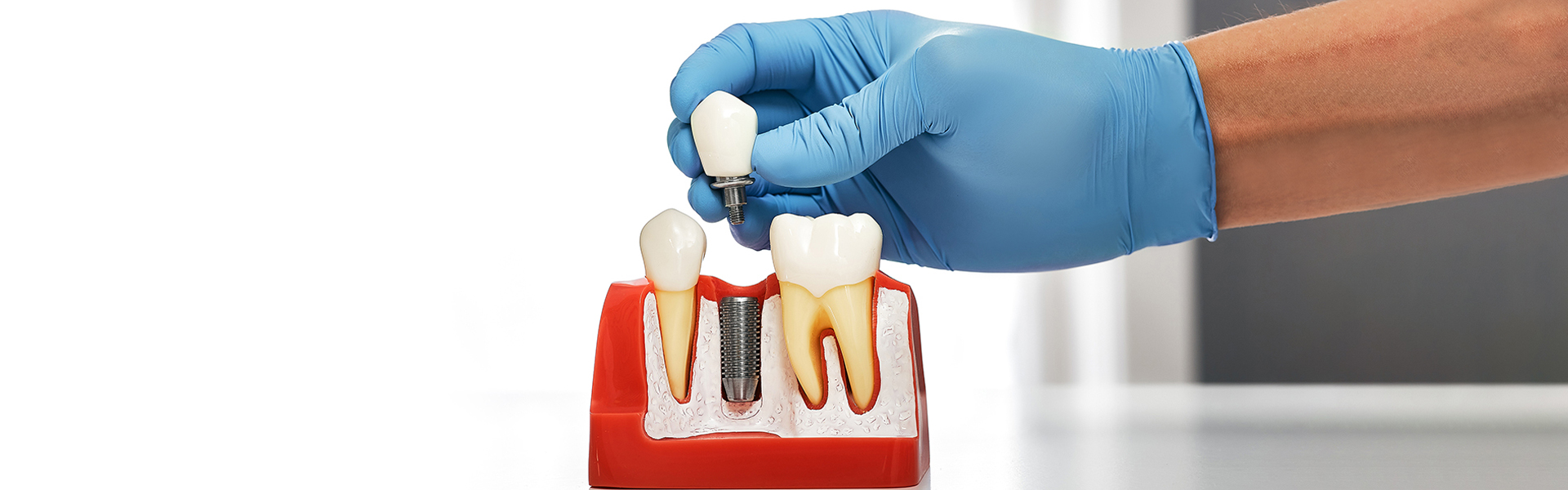 What Are Dental Implants and How Do They Work?