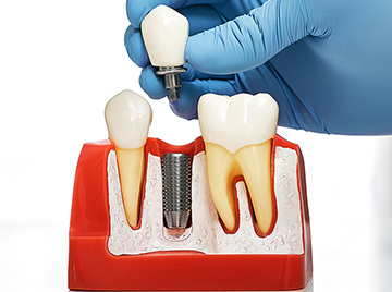 What Are Dental Implants and How Do They Work?