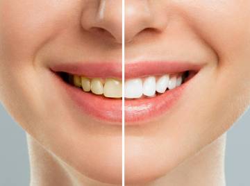 What’s the Right Age for Teeth Whitening?