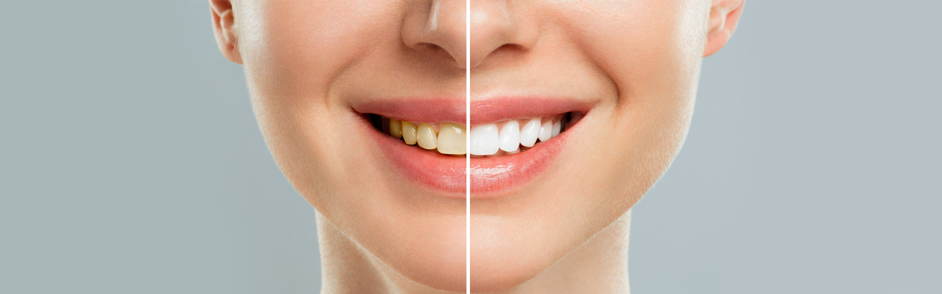 What’s the Right Age for Teeth Whitening?