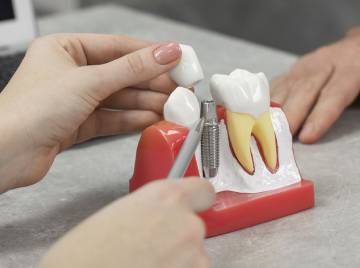 What Happens During Implant Treatment